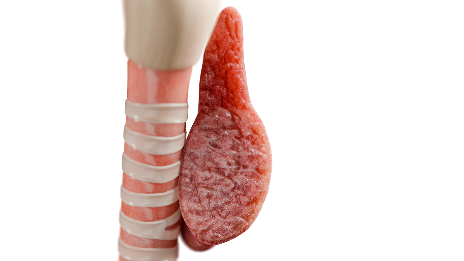 Goitre nodulaire (vue en coupe)