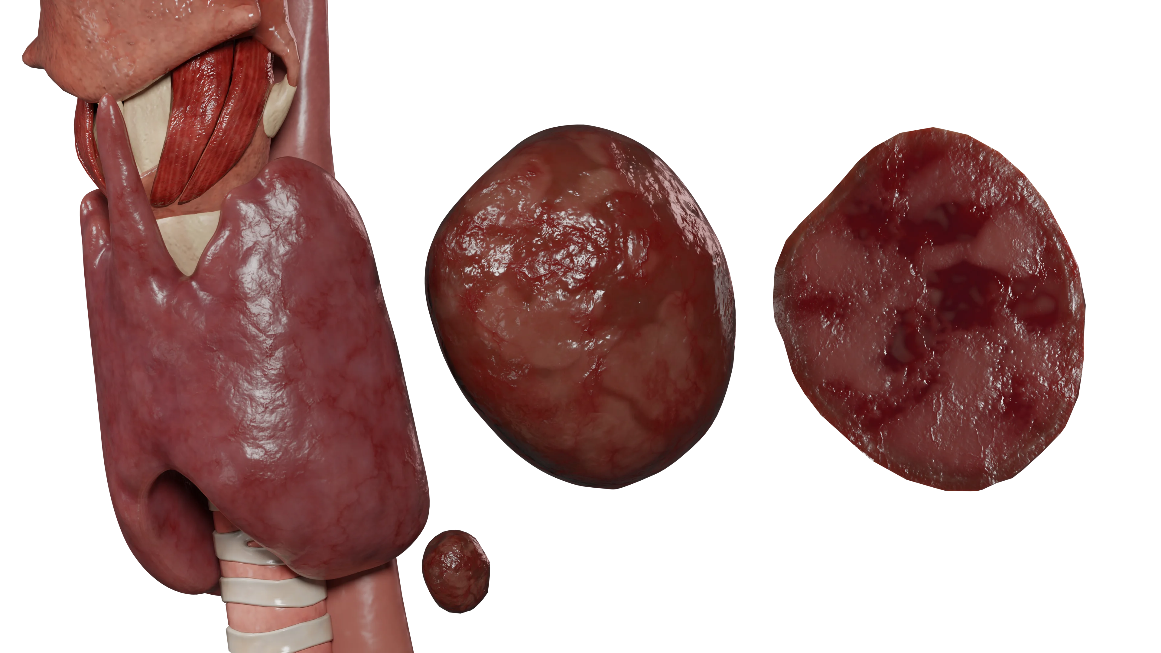 Первичный гиперпаратиреоз