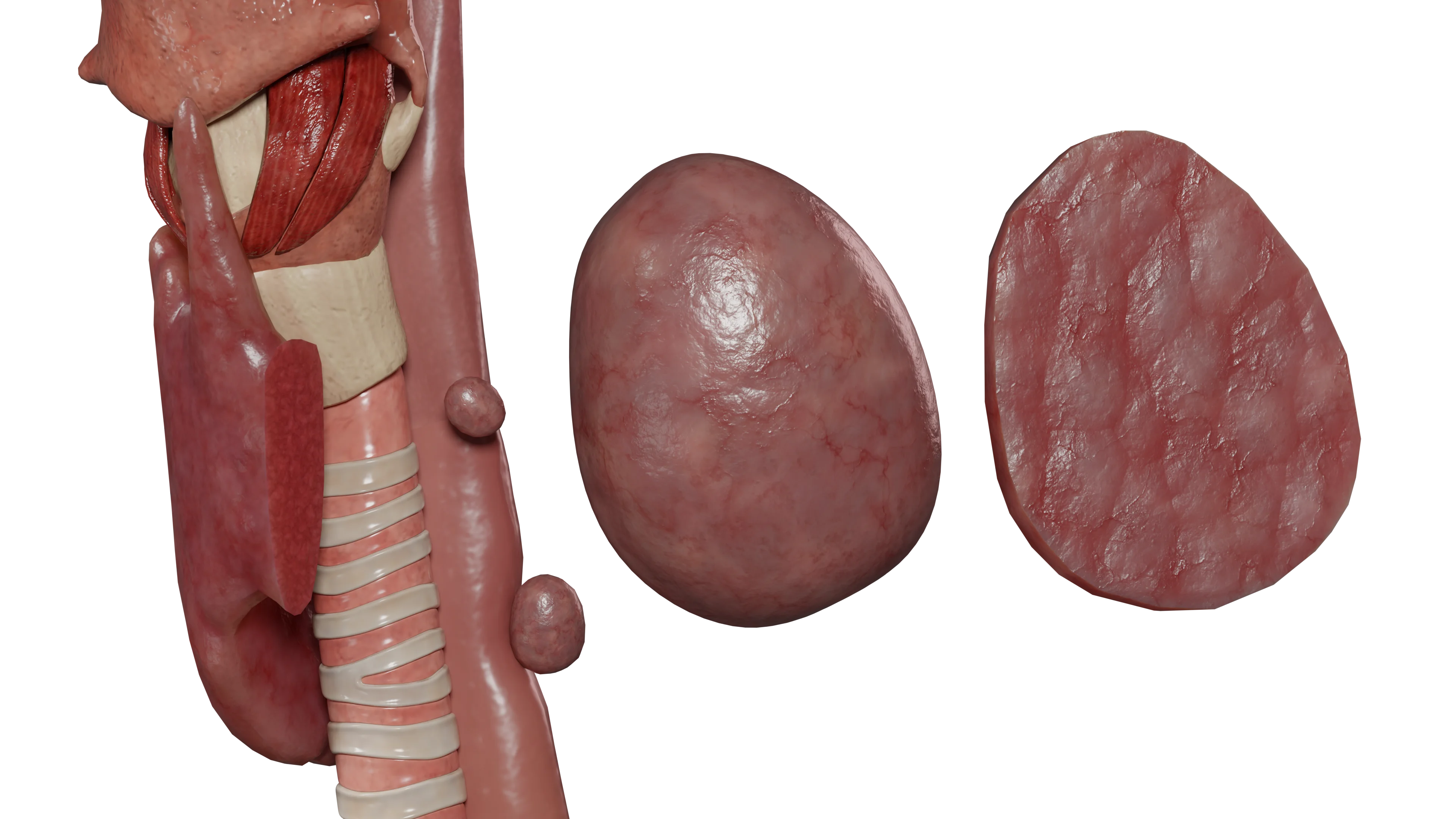 Вторичный гиперпаратиреоз