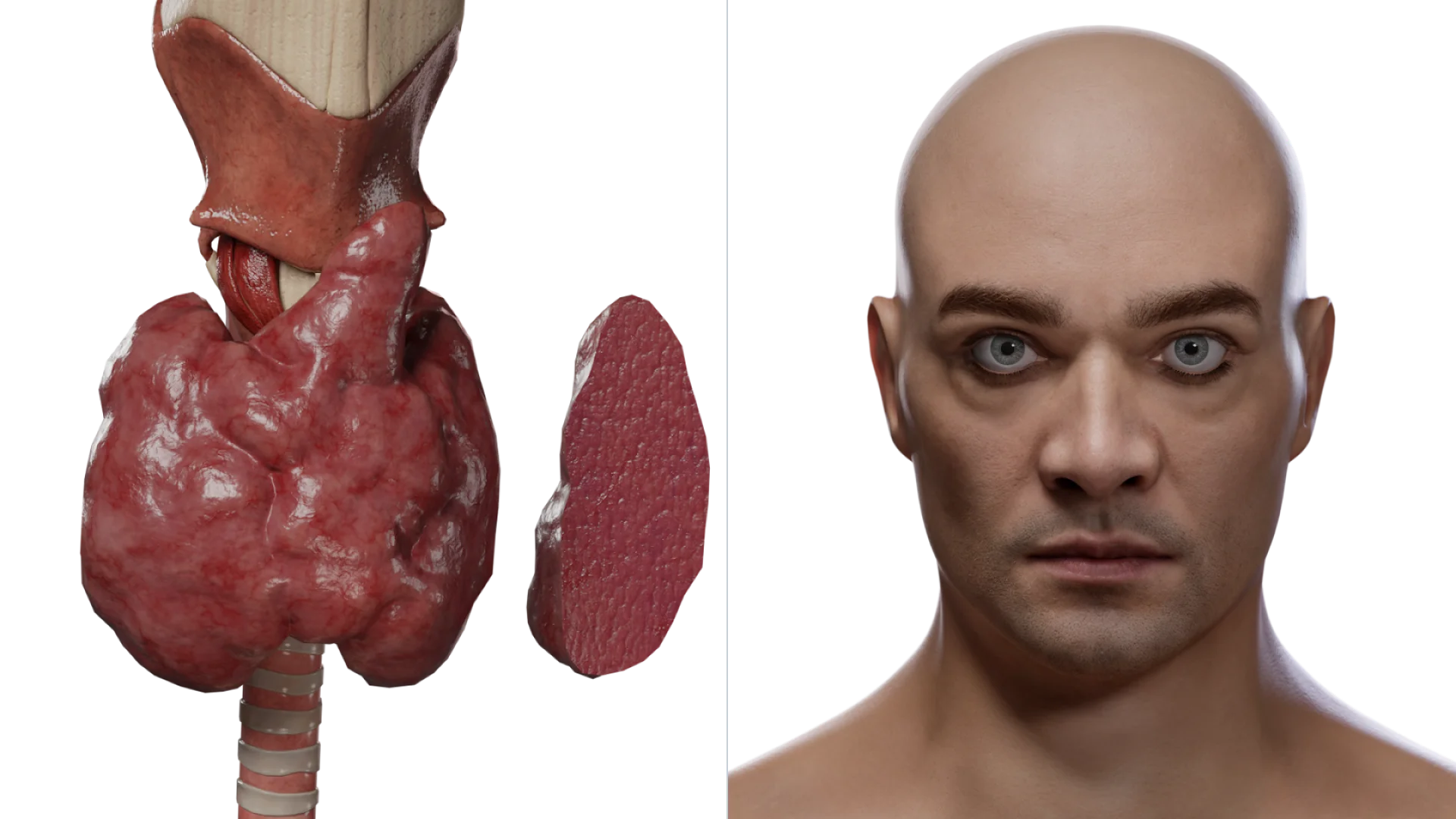 Morbus Basedow: Querschnittansicht der Schilddrüse (links) und Krankheitsmanifestationen (rechts)