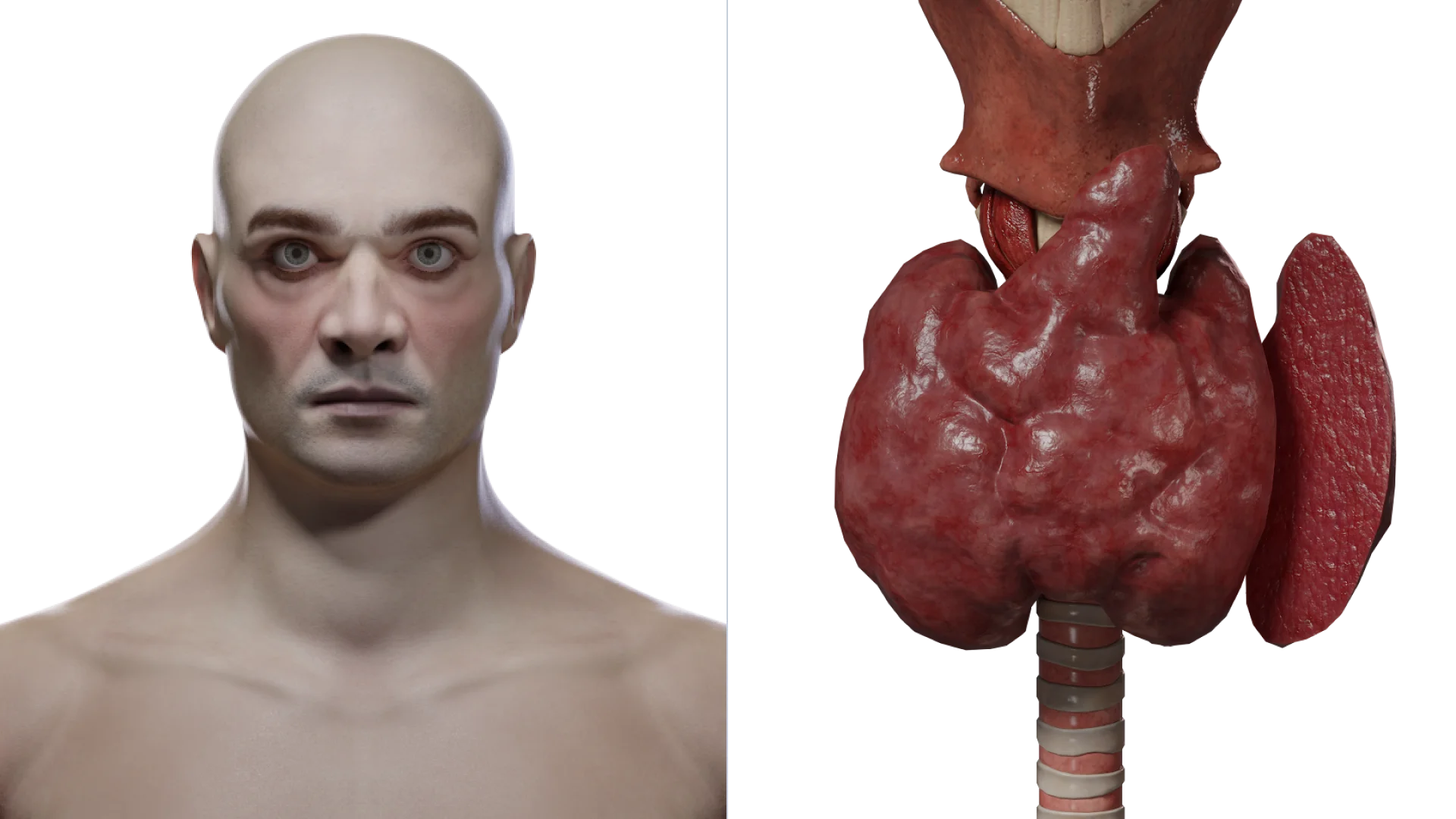 Thyreotoxische Krise: Krankheitsmanifestationen (links) und Aufbau der Schilddrüse (rechts)