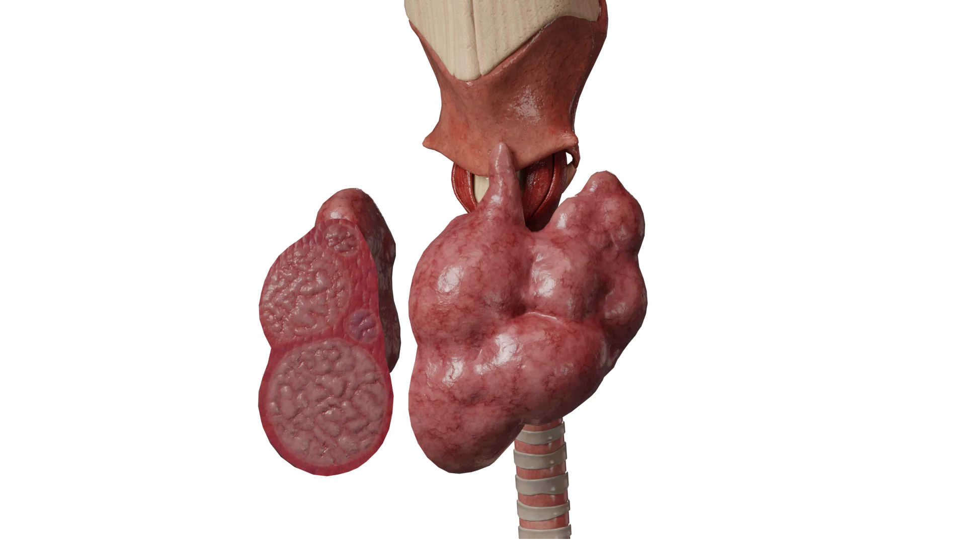 Toxische Knotenstruma