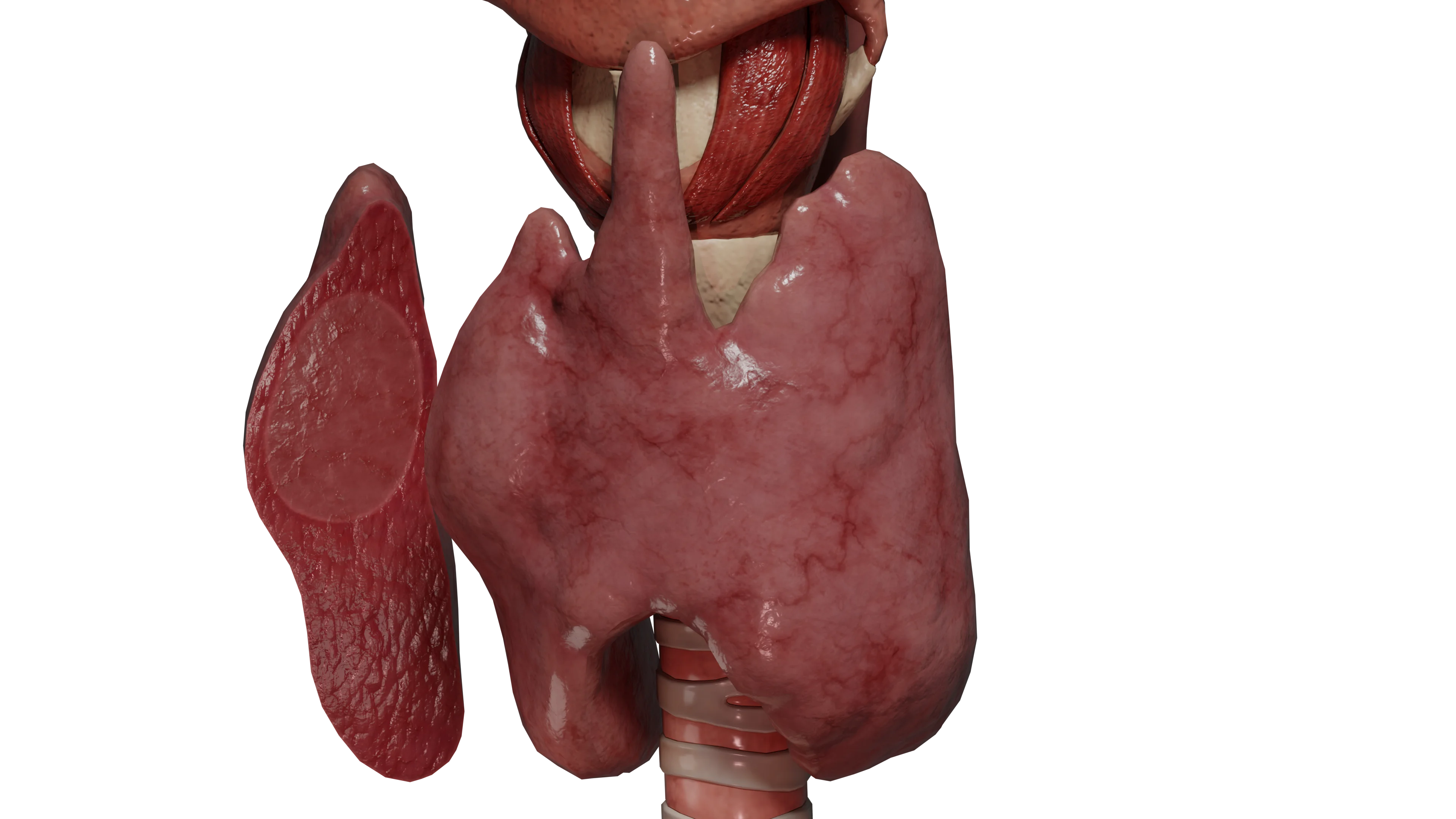 Toxisches Schilddrüsenadenom