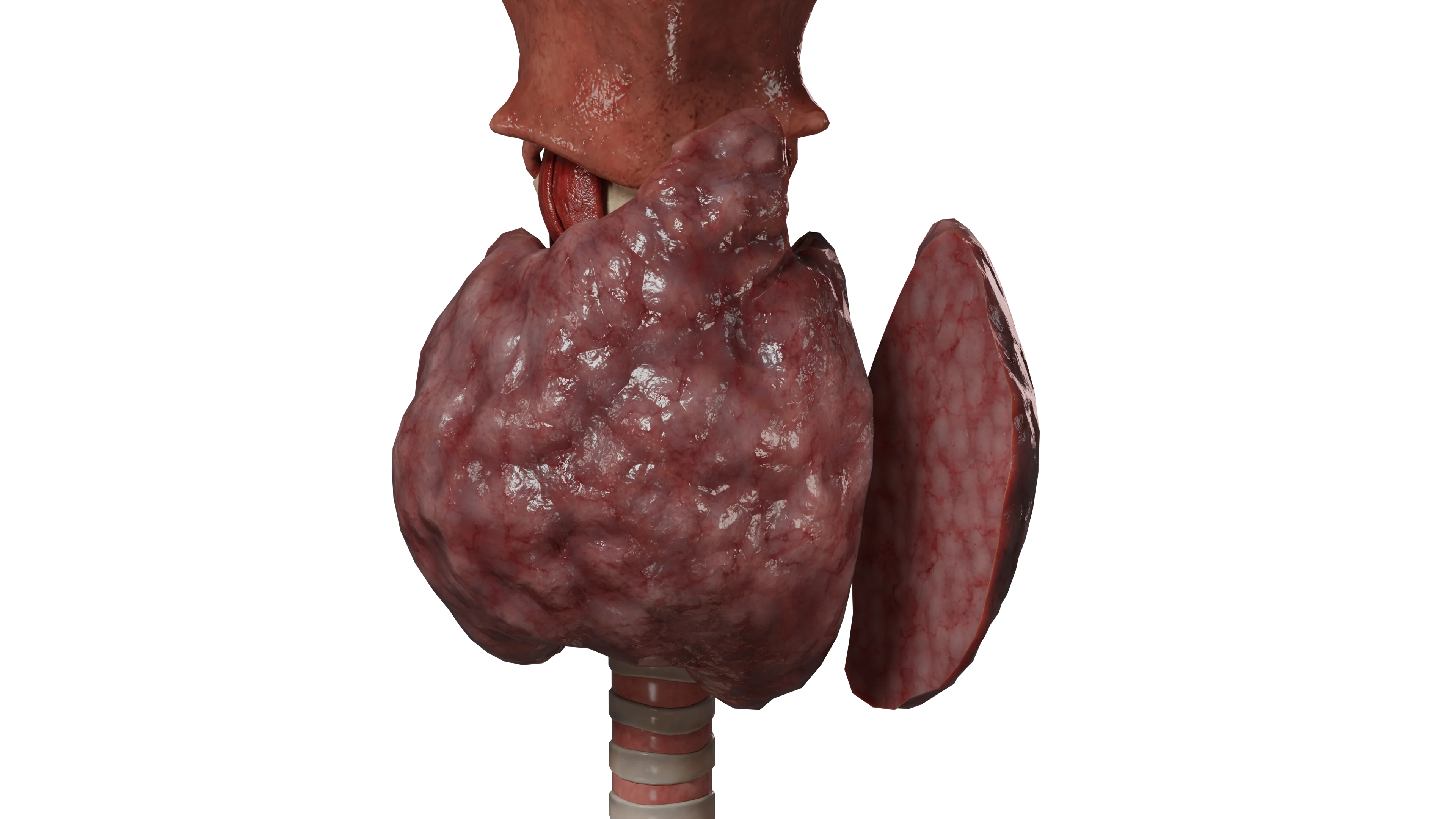 Приобретенный гипотиреоз