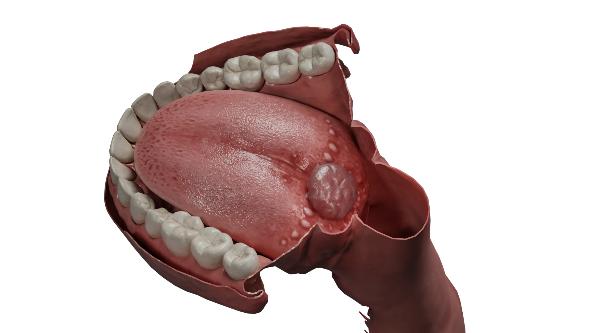 Lingual ectopia of the thyroid gland