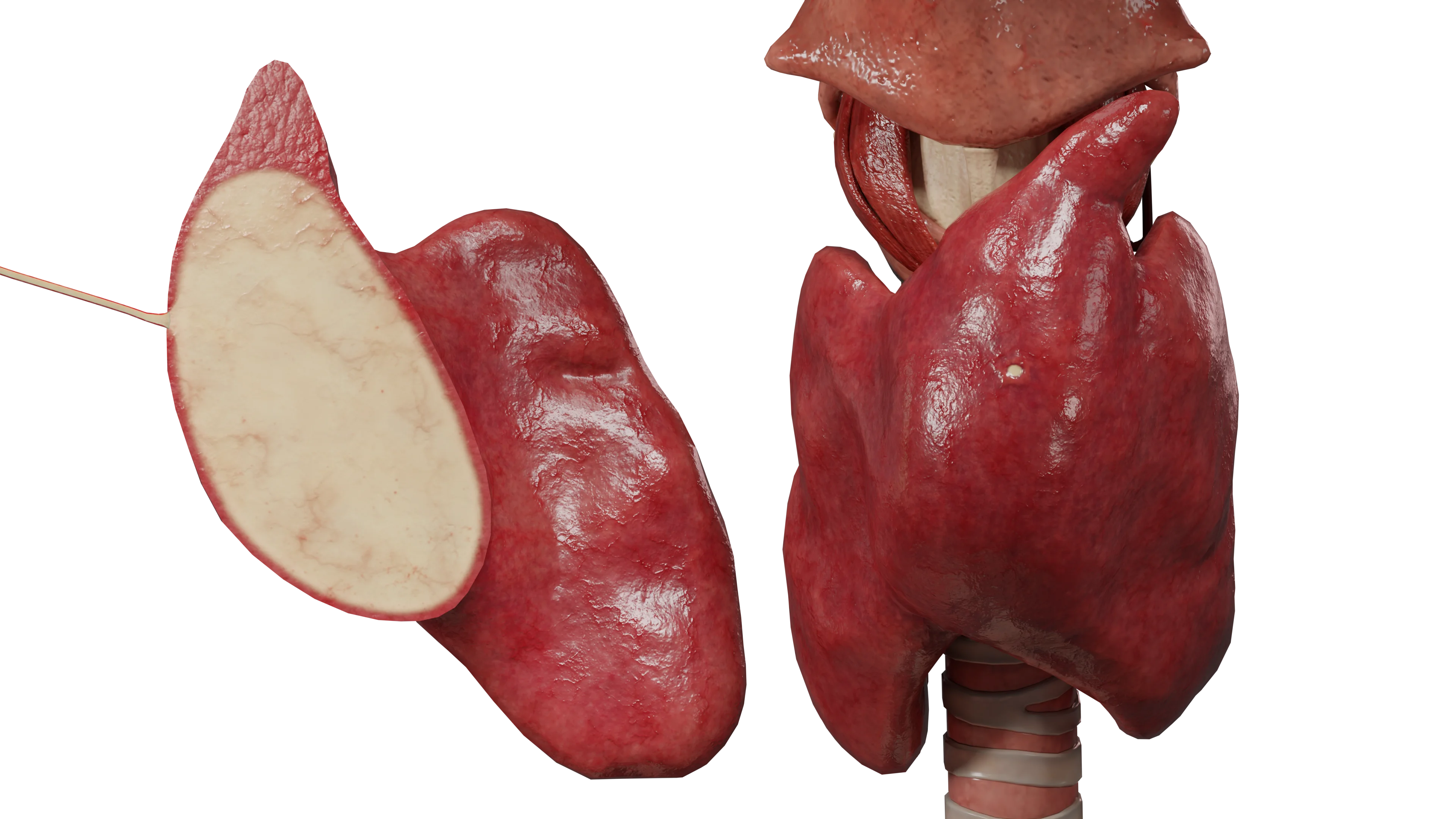 Абсцесс щитовидной железы