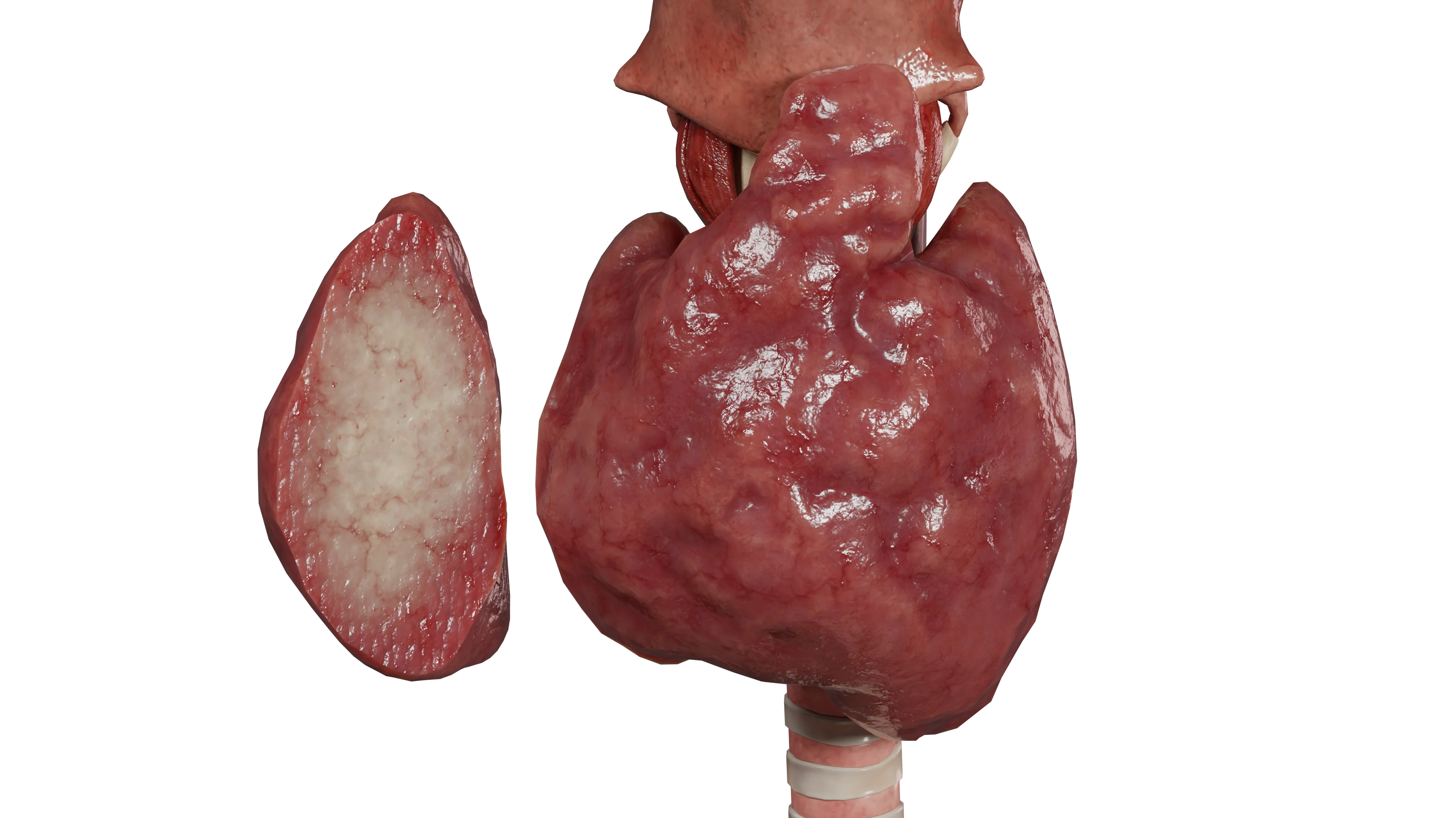 Подострый тиреоидит де Кервена