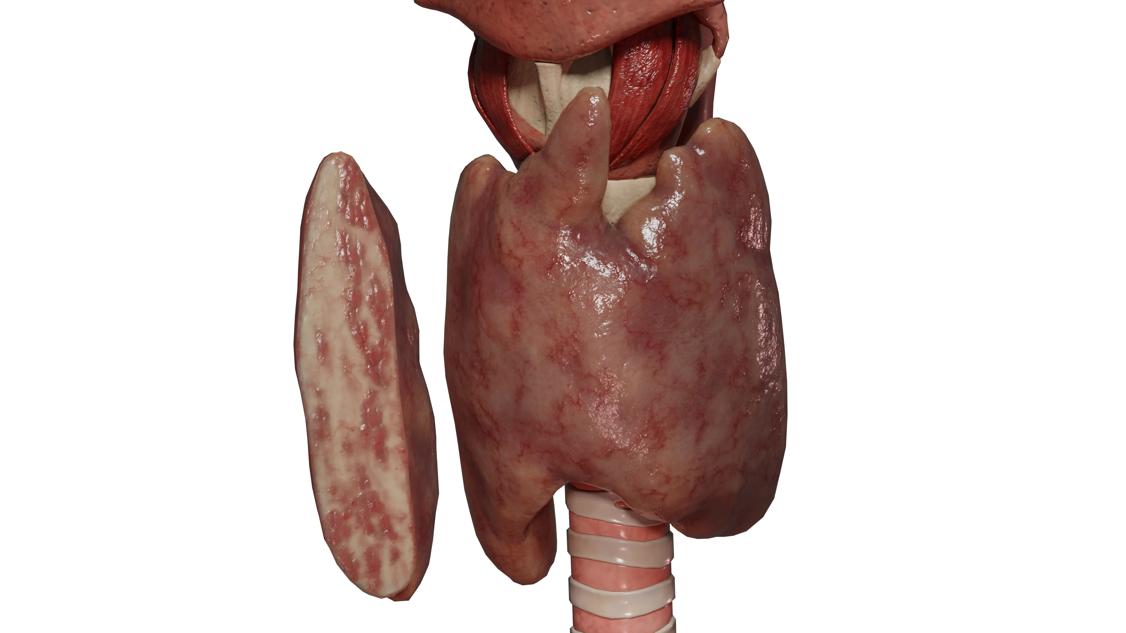 Радиационно индуцированный тиреоидит