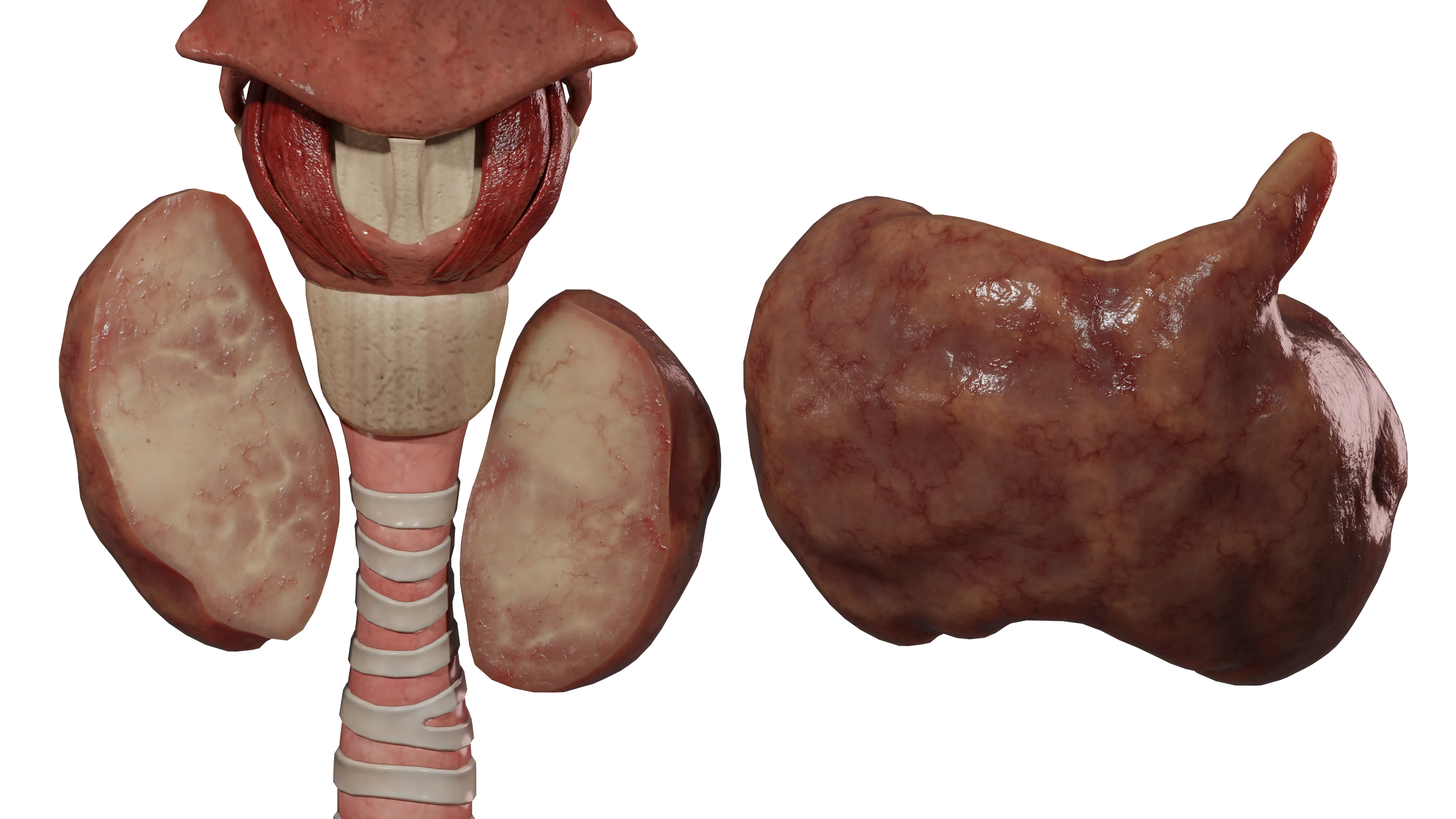 Тиреоидит Риделя