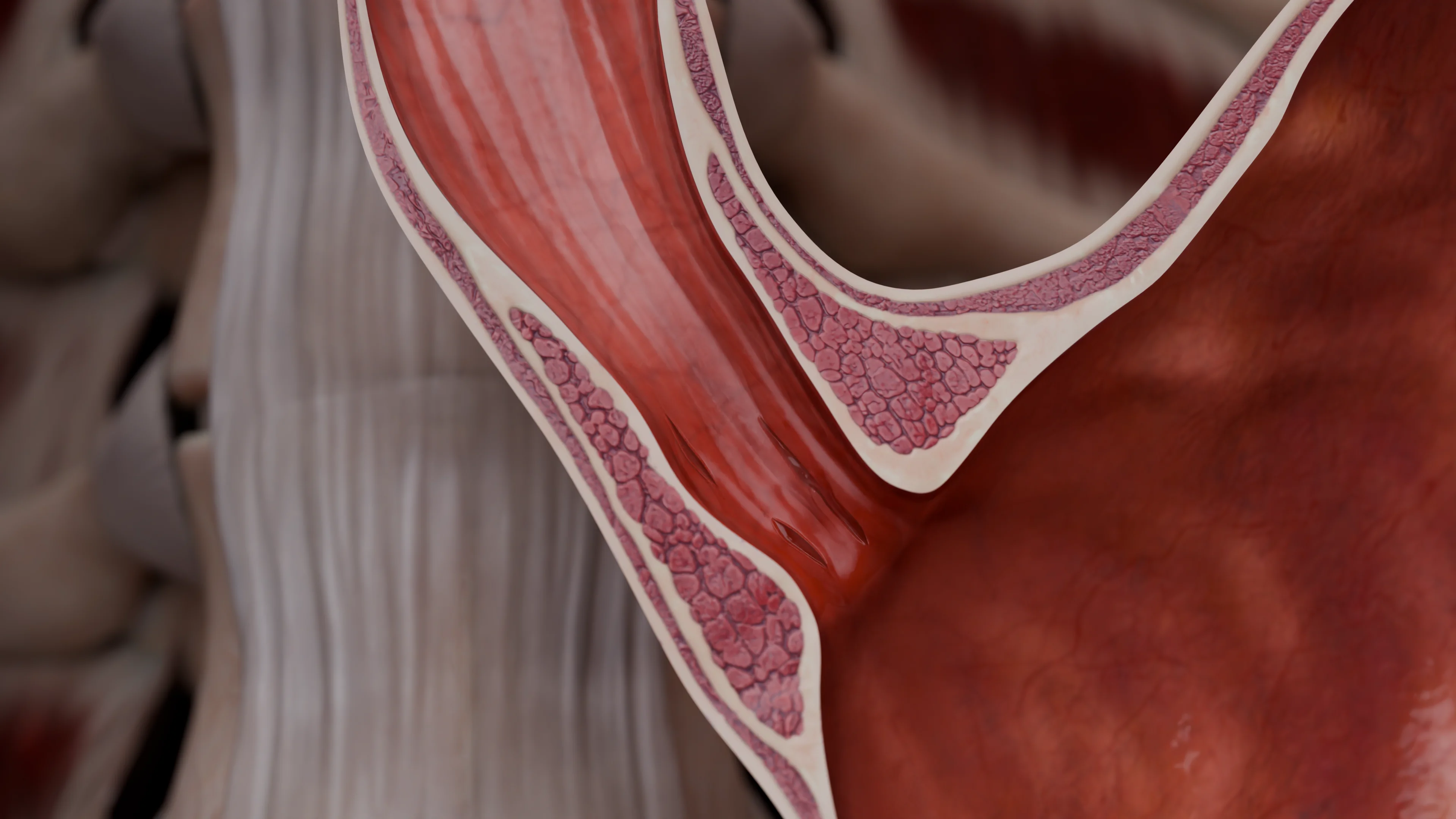 Рефлюкс-эзофагит - степень B - 3D-модель