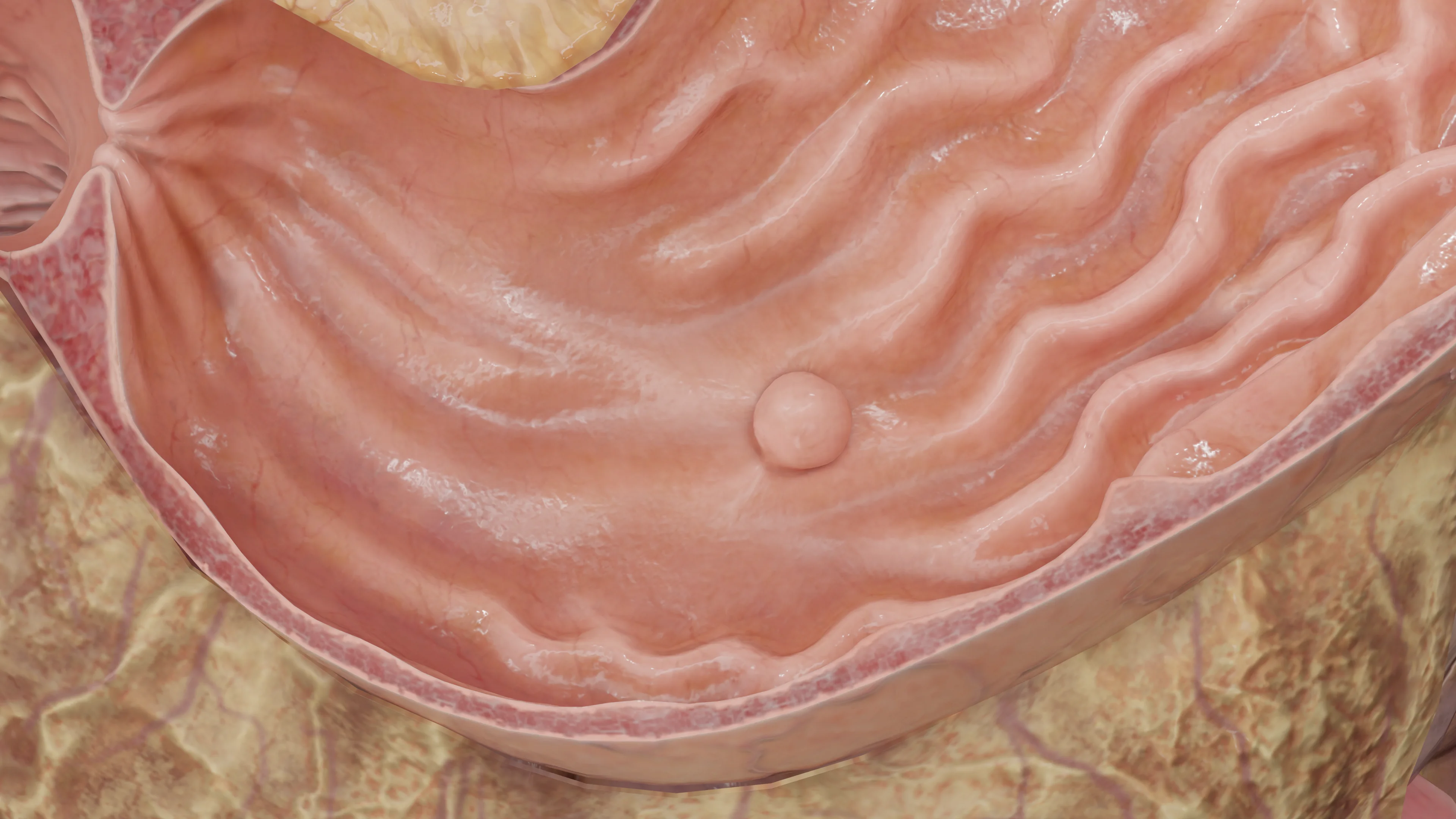 Одиночный полип в теле желудка