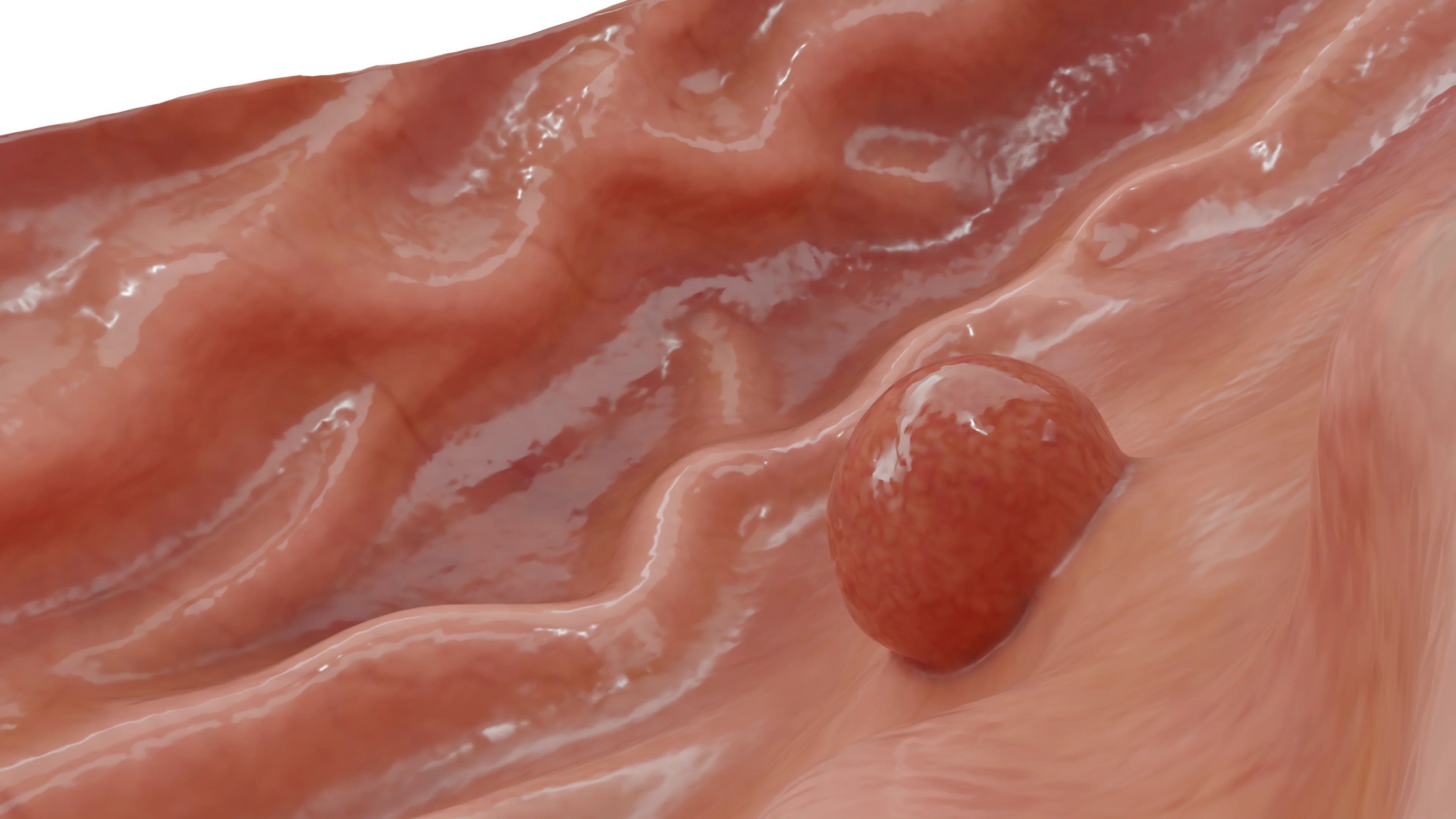 Аденоматозный полип желудка