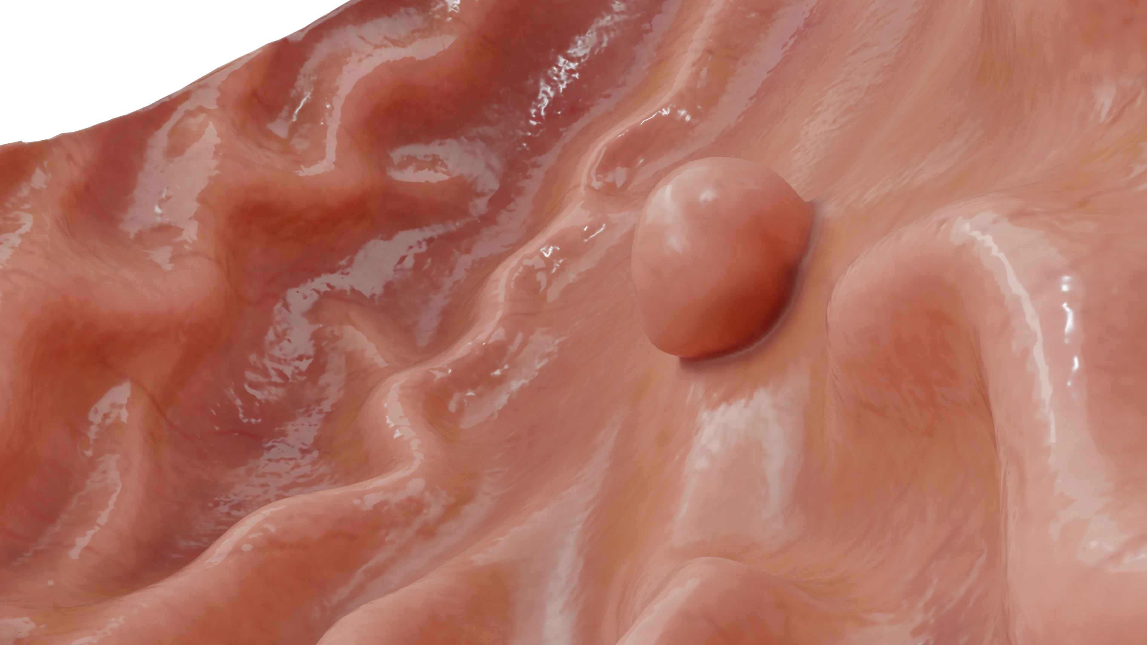 Гиперпластический полип желудка
