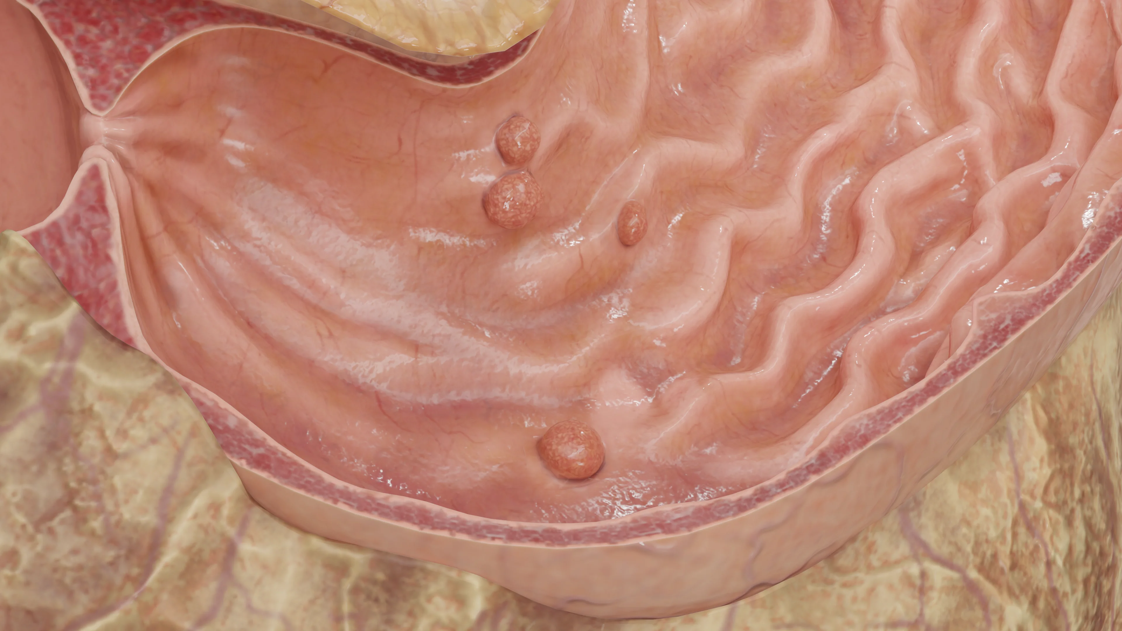 Полипы желудка: этиология, классификация, диагностика и методы лечения