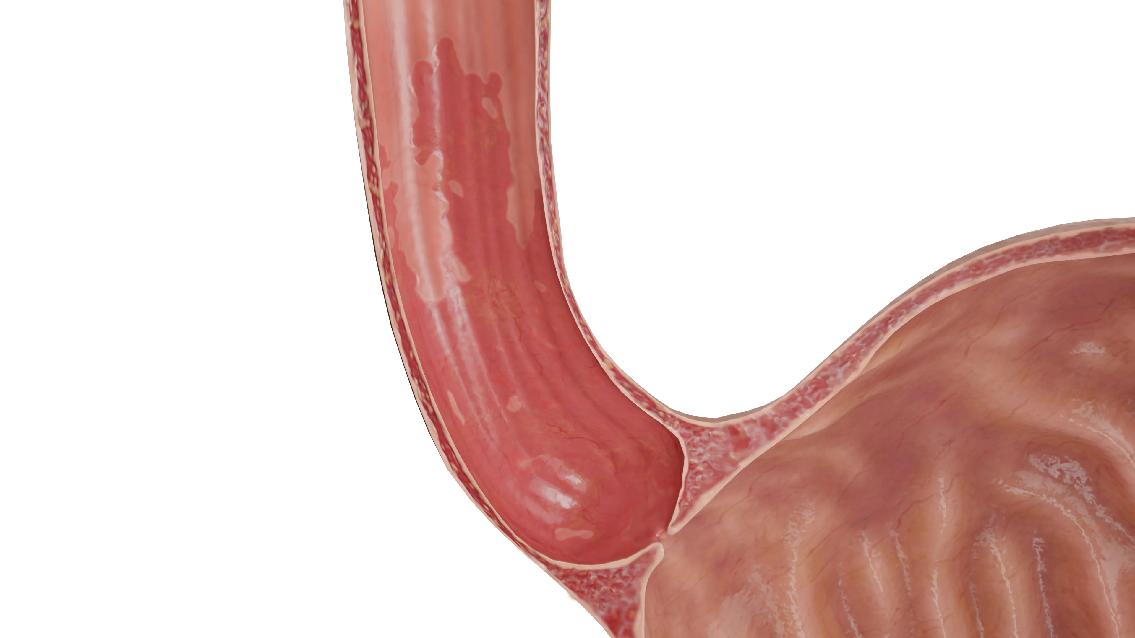 Пищевод Барретта как исход длительного ГЭРБ - является предраковым заболеванием
