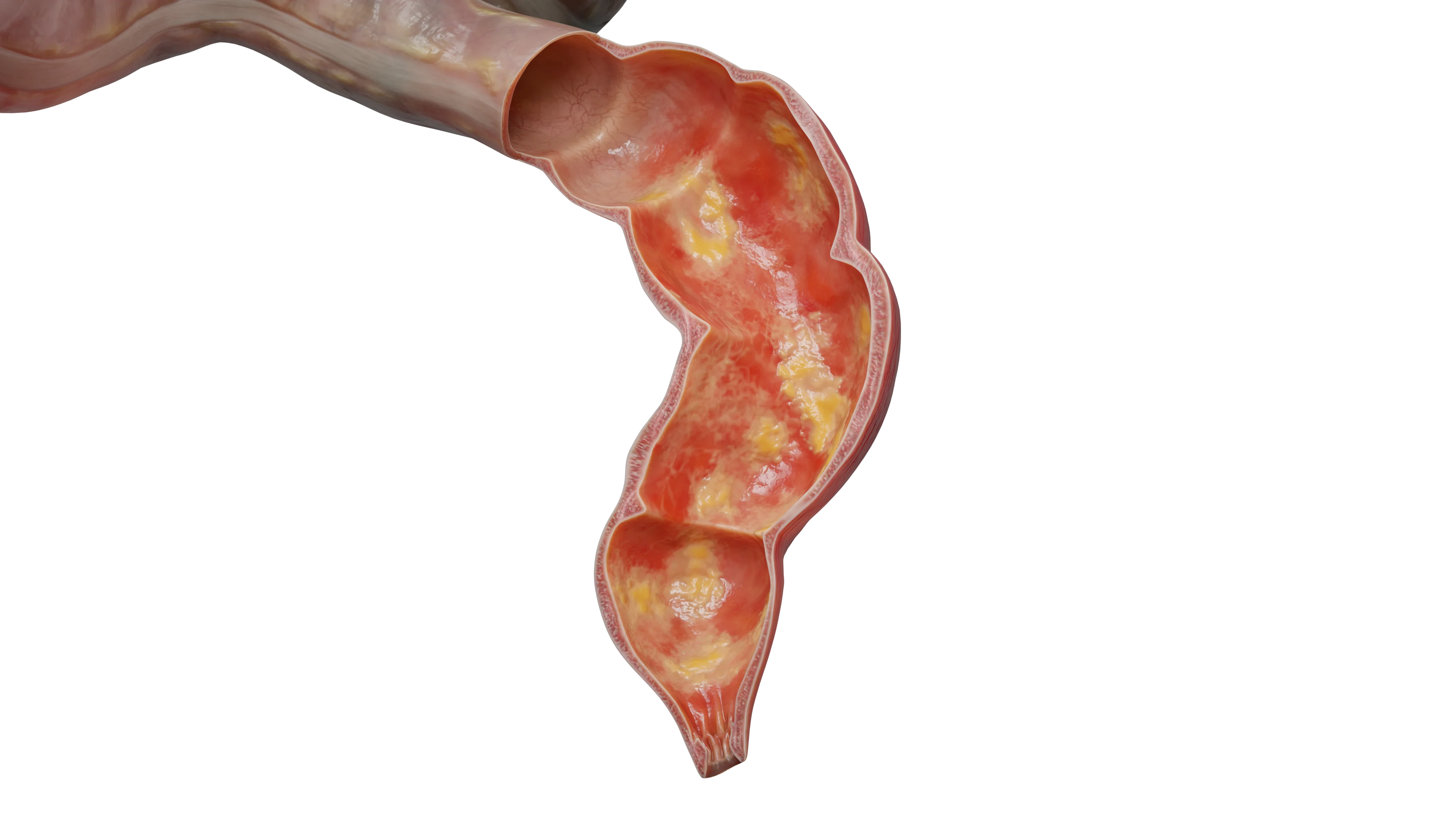 Язвенный колит (НЯК): классификация, симптомы, диагностика и лечение