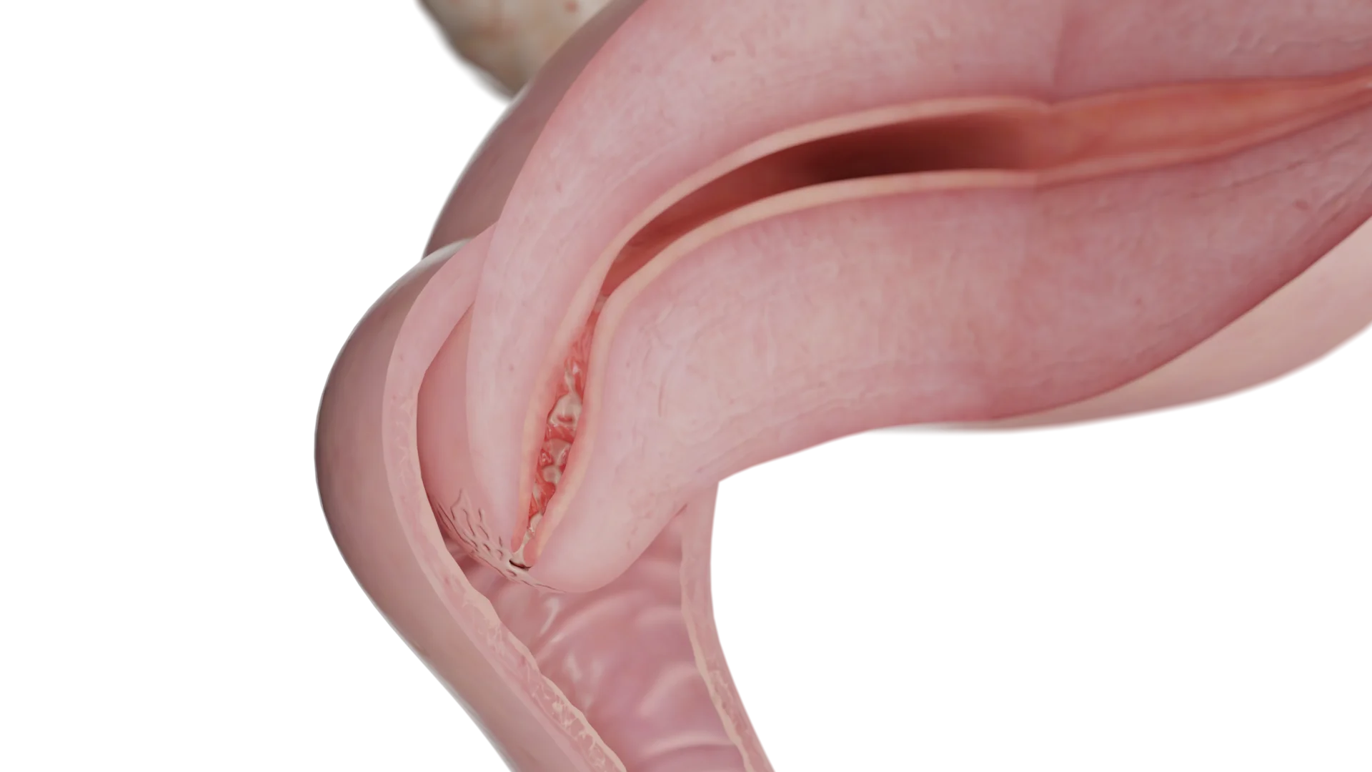 Cervicite : étiologie, symptomatologie, diagnostic, traitement