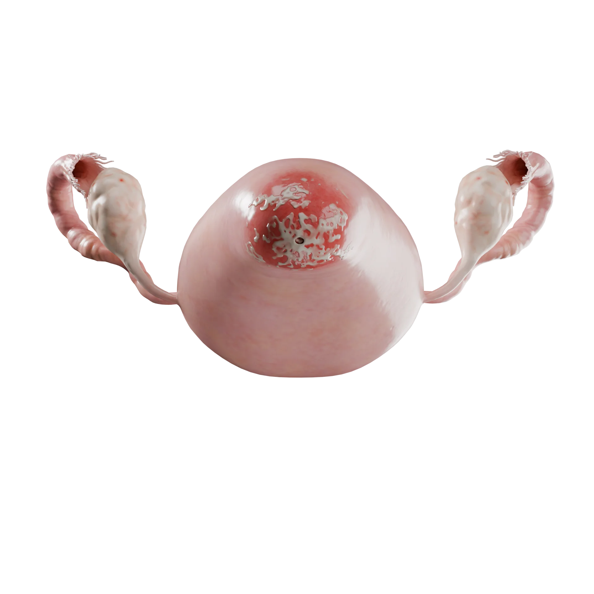 Cervix: Diffuse Exocervicitis