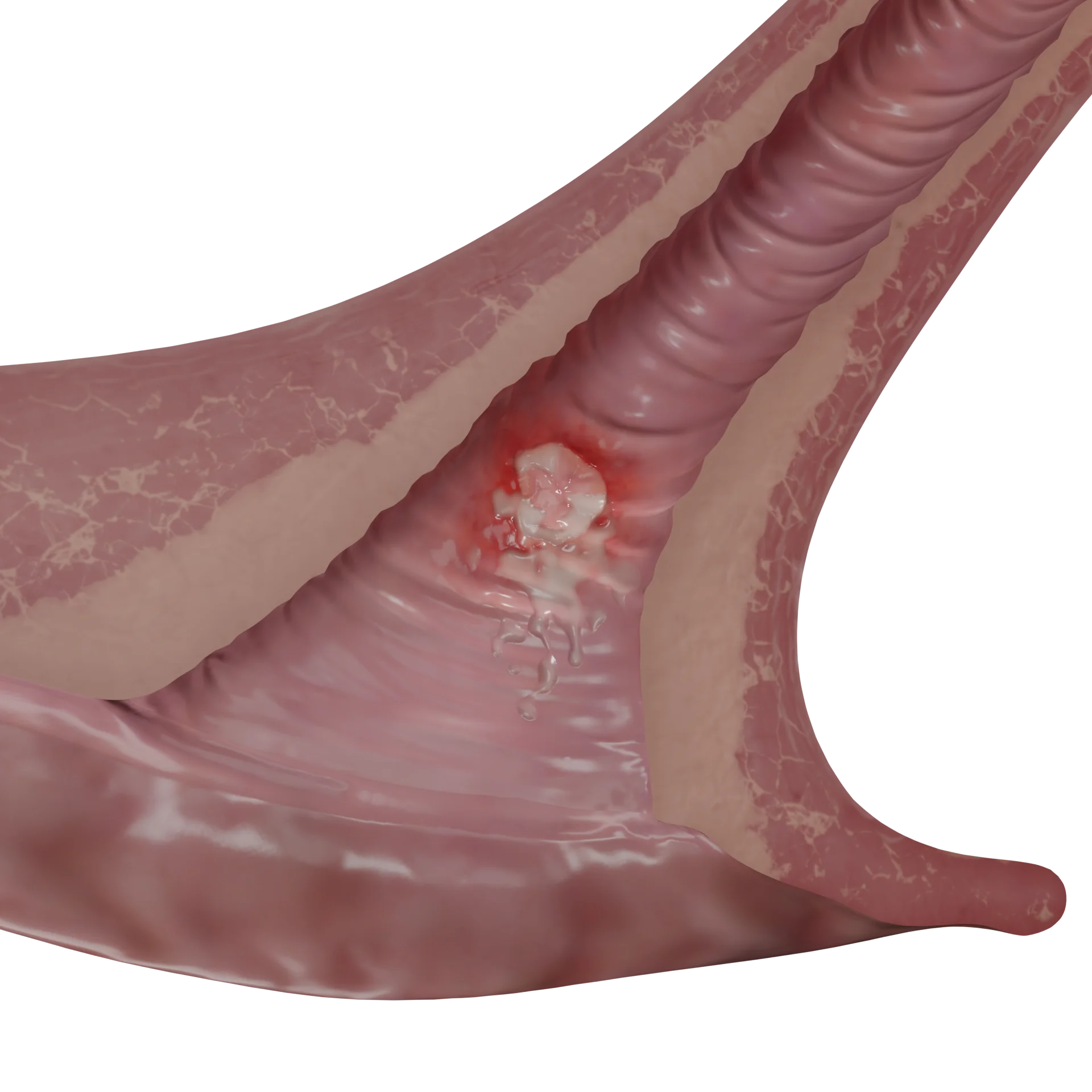 Syphilitic Vaginitis: Symptoms, Diagnosis, Treatment