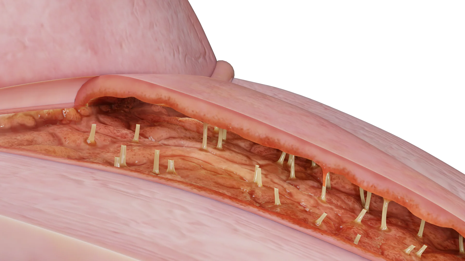 Endométrite tuberculeuse : paroi utérine postérieure