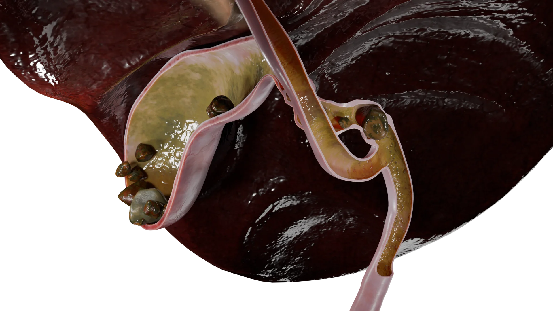 Multiple Gallstones in Gallbladder and Cystic Duct