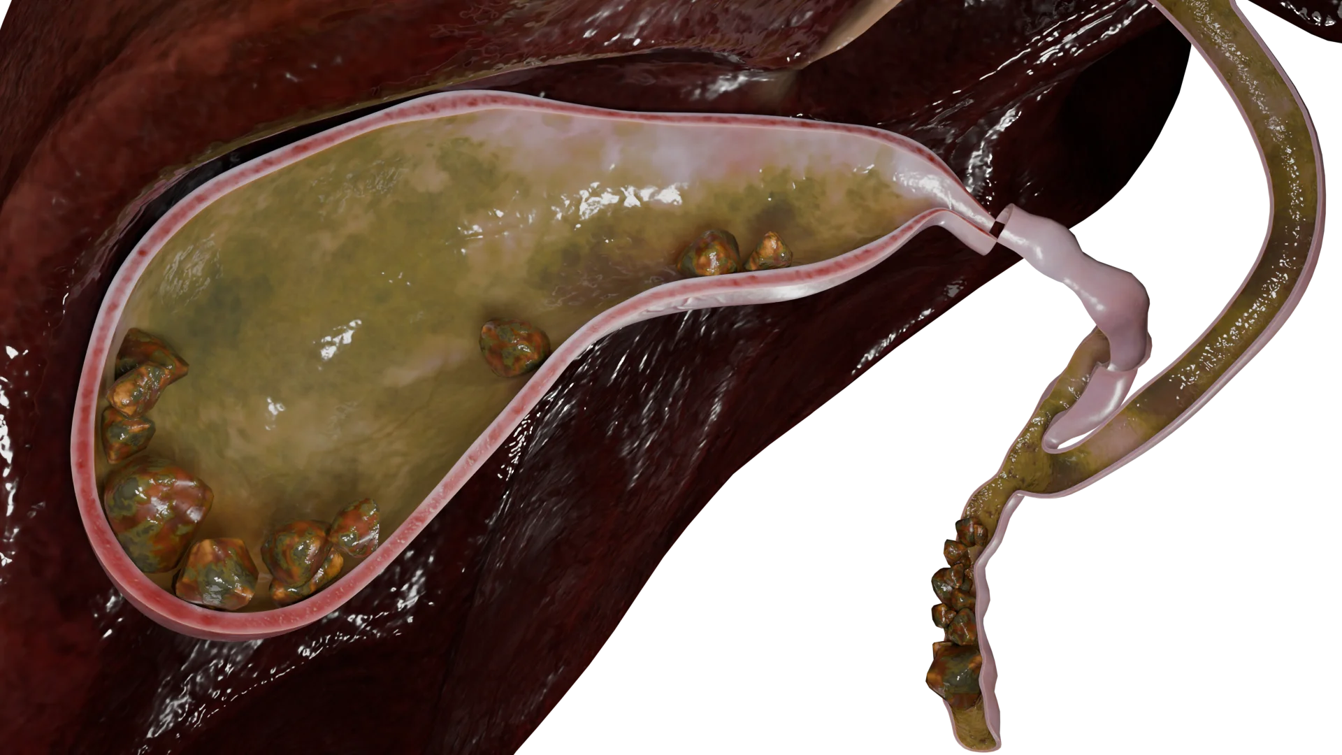 Multiple Gallstones in Gallbladder and Bile Duct