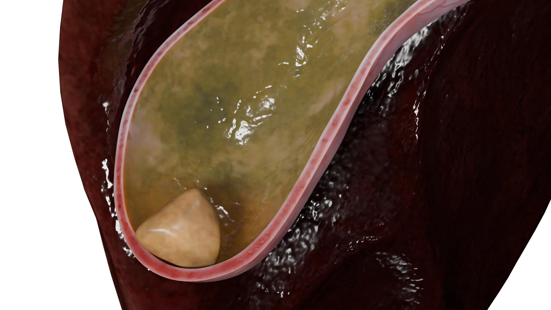 Single cholesterol calculus in the gallbladder