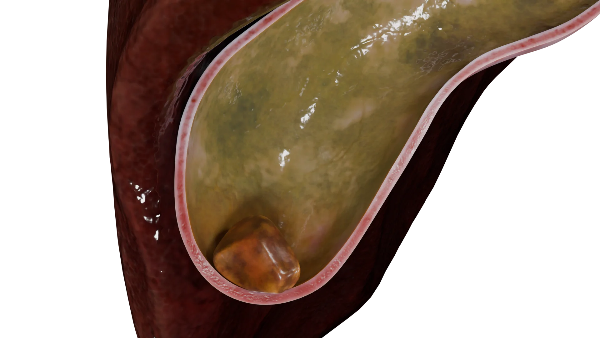 Single pigment calculus in the gallbladder