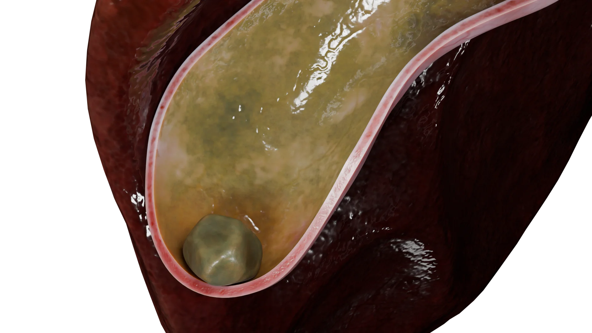 Single mixed calculus in the gallbladder