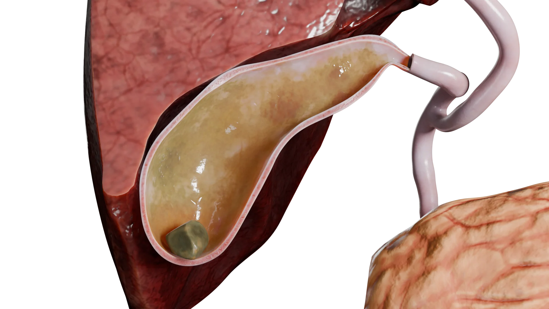 Single mixed calculus in the gallbladder without cholecystitis