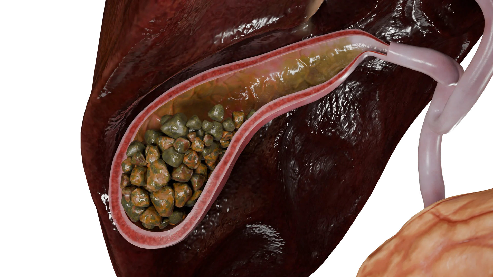 Multiple mixed calculi in the gallbladder with acute cholecystitis