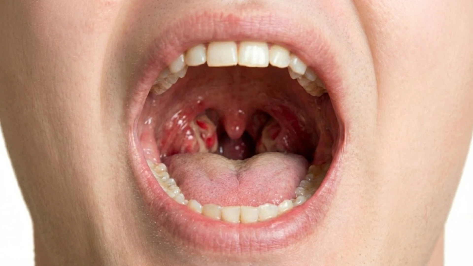 Поражение ротоглотки при инфекционном мононуклеозе