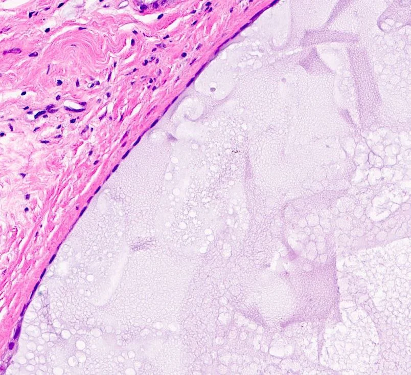 Thickened epithelial lining