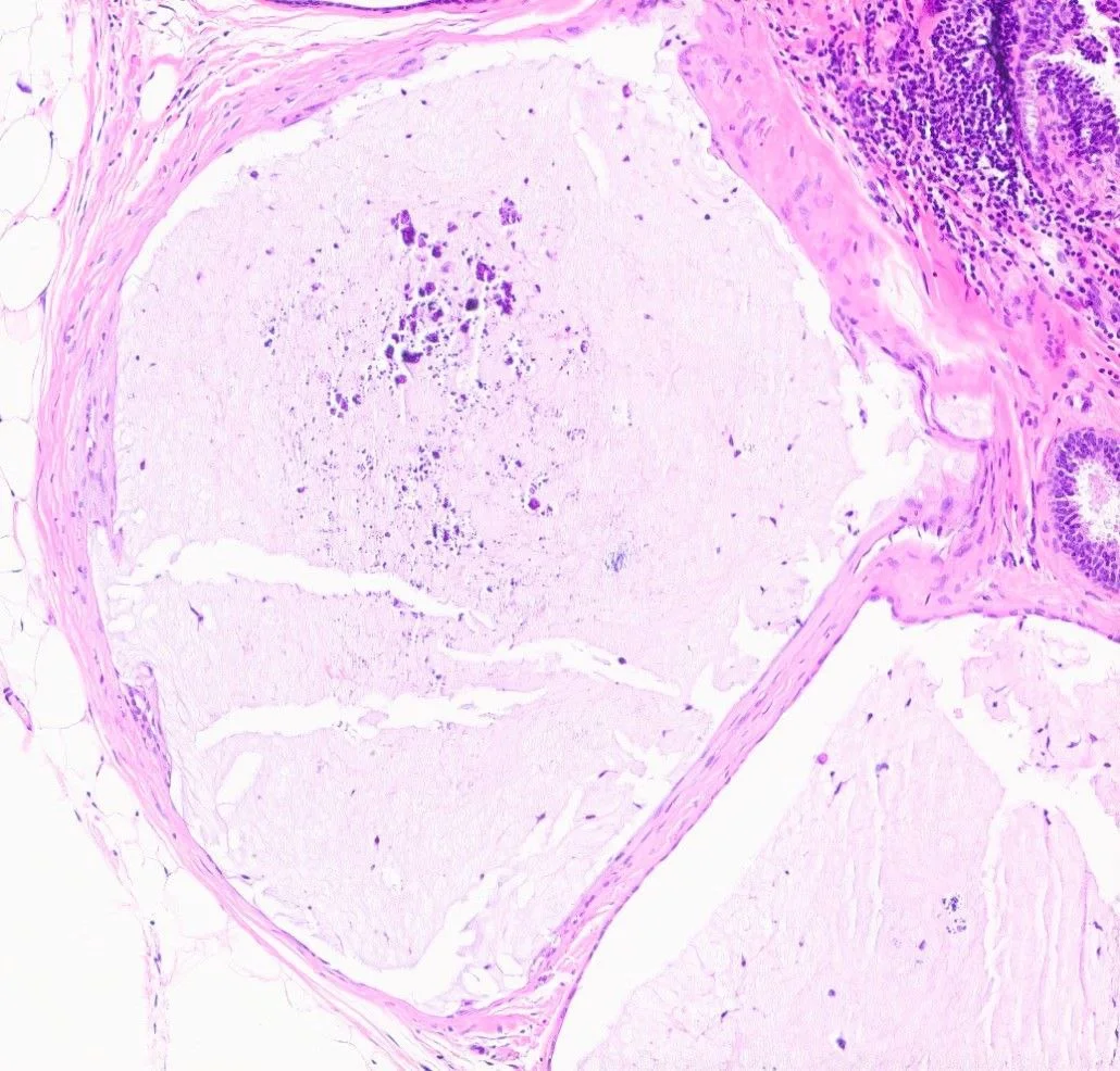 Absence of epithelial lining
