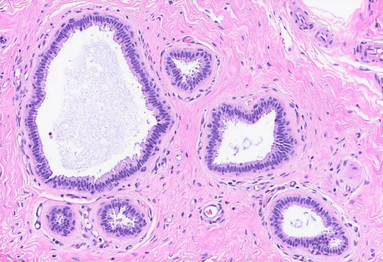 A group of cysts lined by columnar epithelium