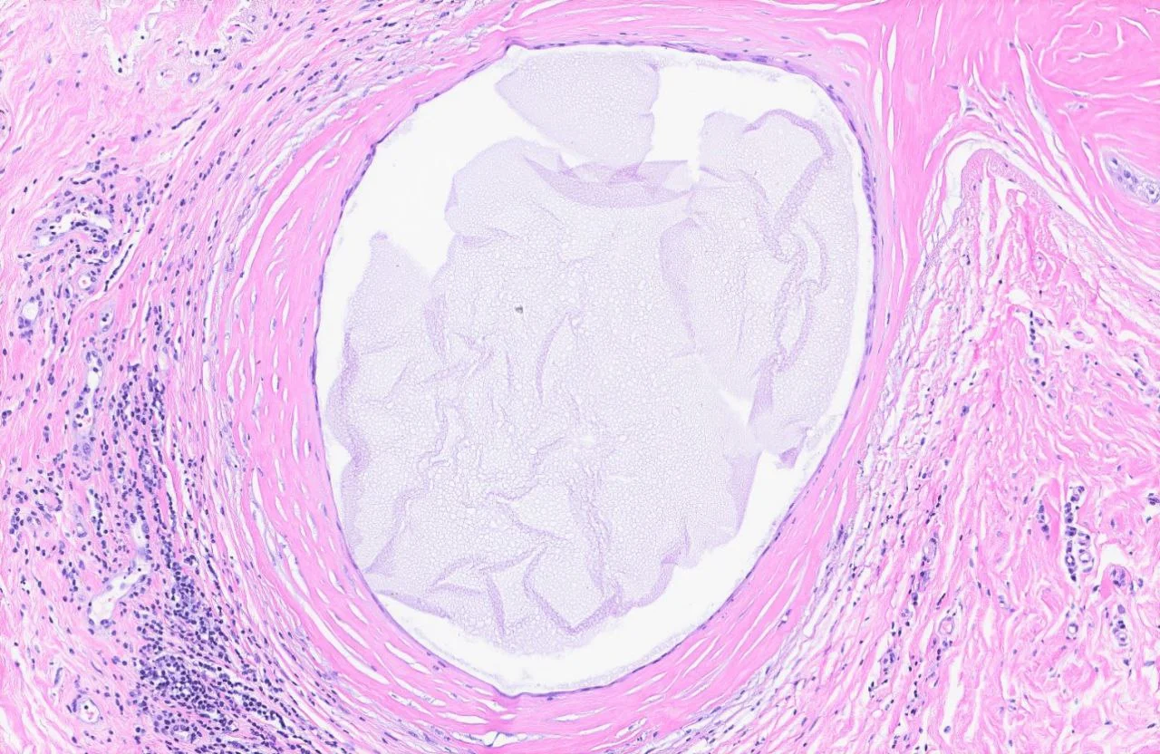 Fibrosis with surrounding inflammation