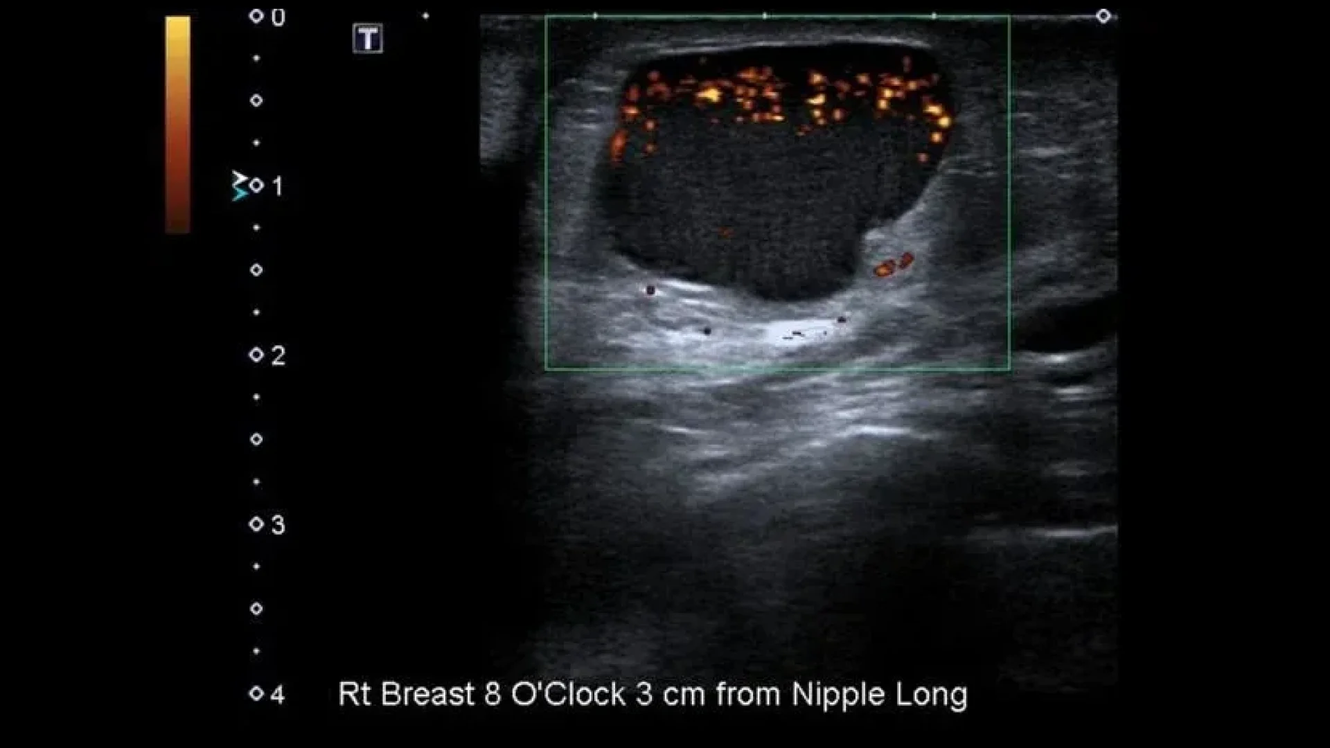 Ultrasound with Doppler ultrasonography of a simple large breast cyst