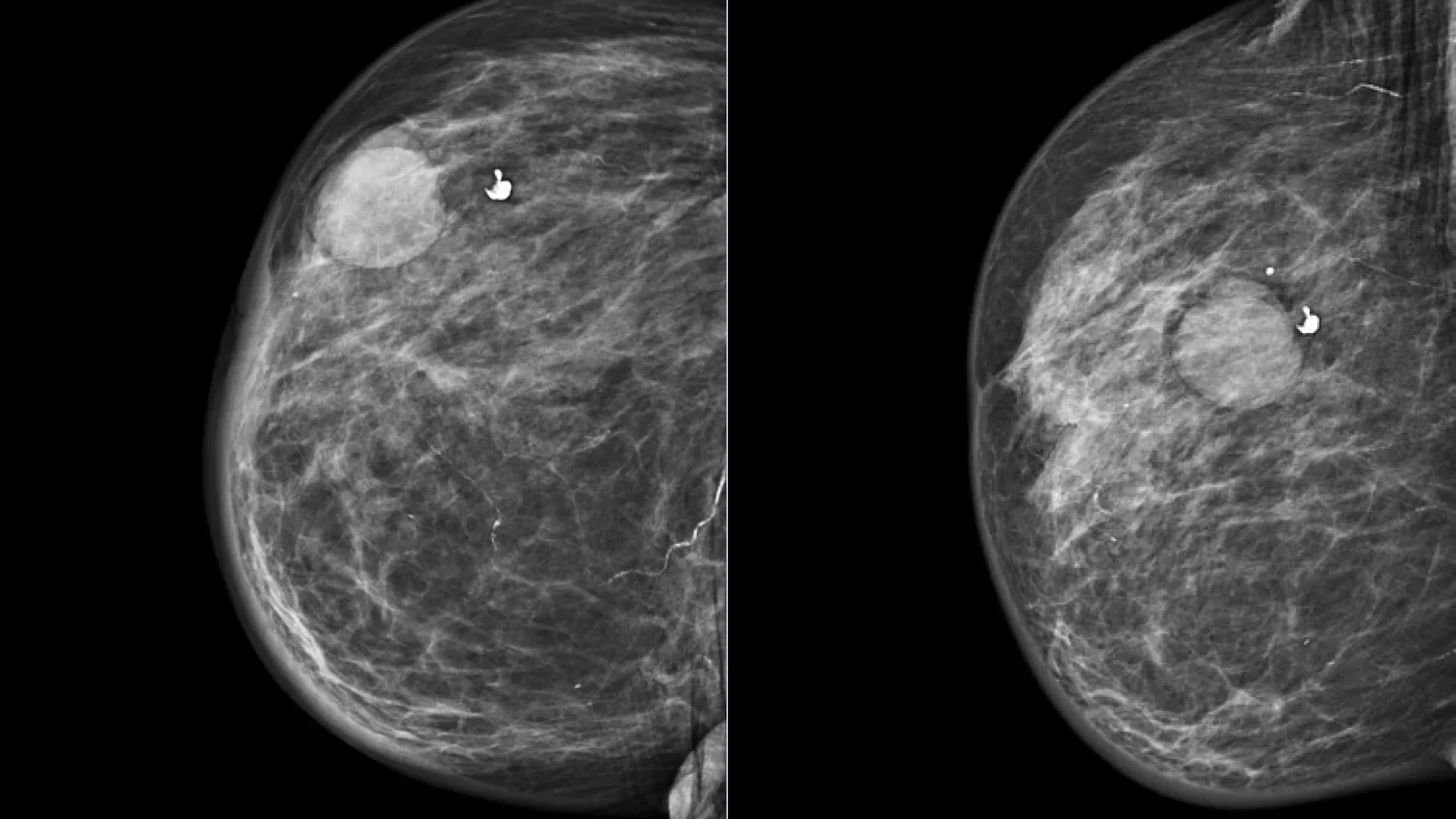 Mammography of the right breast in two projections: a breast cyst