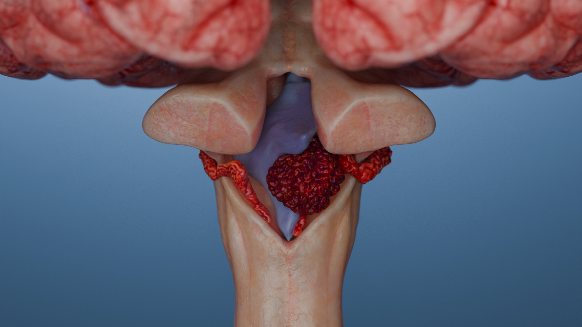 Plexus-chorioideus-Tumoren: Plexuspapillome und Plexuskarzinome. Ätiologie, Klassifikation und Therapie