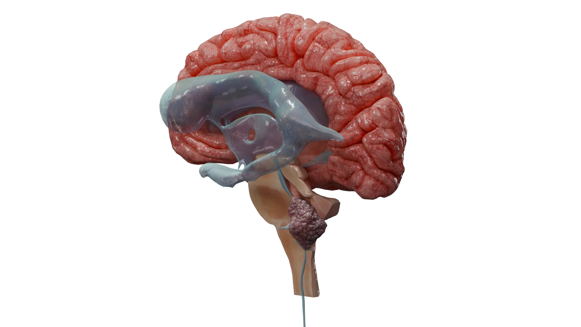 Инфратенториальная эпендимома головного мозга