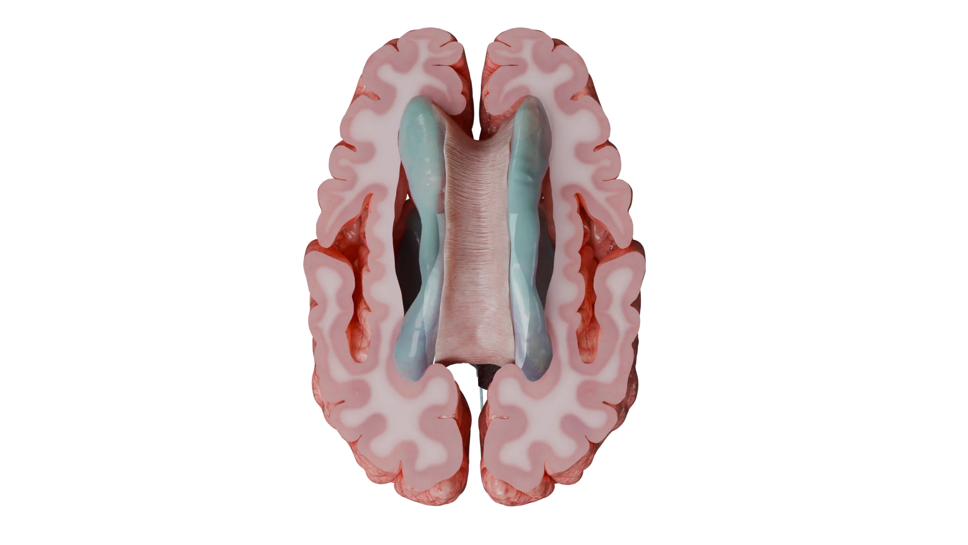 Боковые желудочки - типичное место возникновения супратенториальных эпендимом