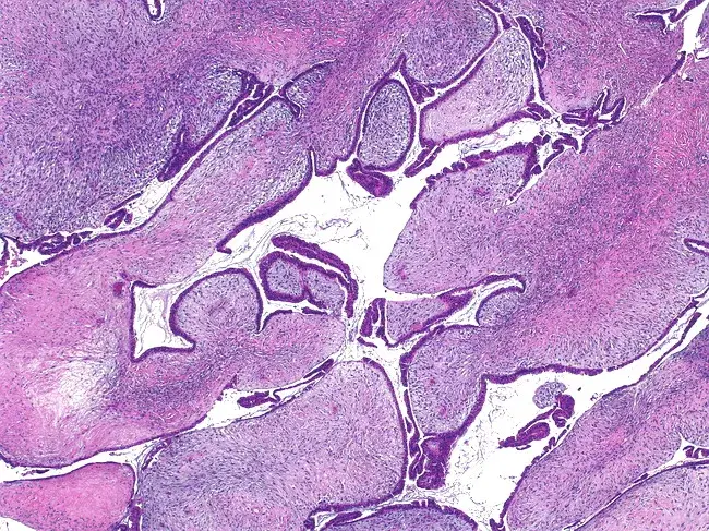 Phyllodes tumour: structure of the stroma and glandular epithelium