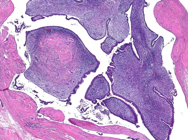 Low-grade phyllodes tumour with expansion of slit-like spaces and formation of cysts with papillary structures
