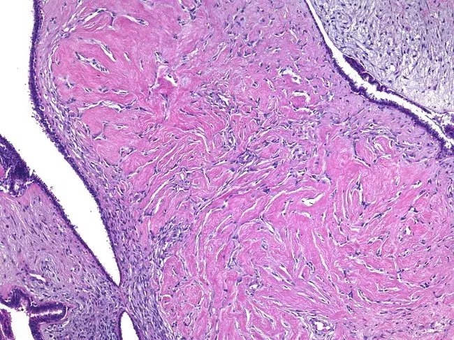 Histological features of low-grade phyllodes tumour with pseudoangiomatous stromal hyperplasia (PASH)-type stromal changes