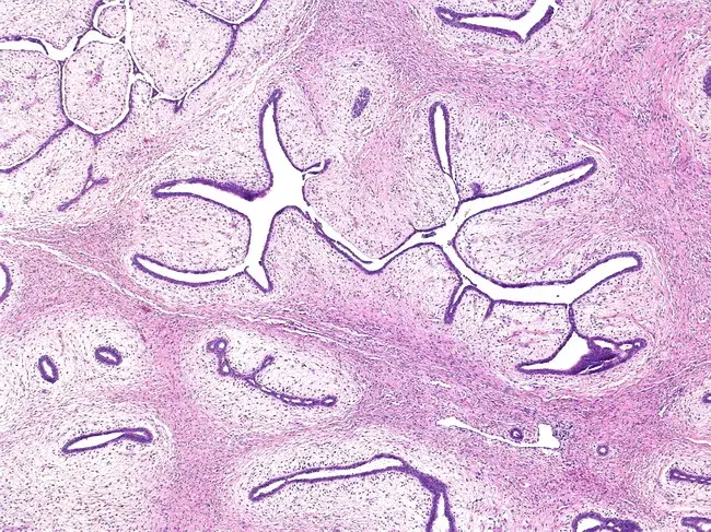 Phyllodes tumour with periductal stromal proliferation and nodular structure