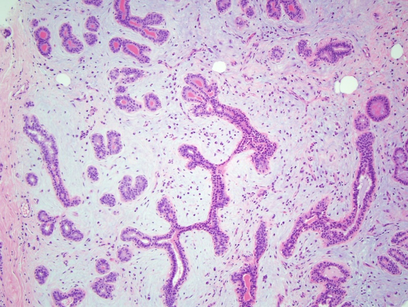 Myxoid fibroadenoma.