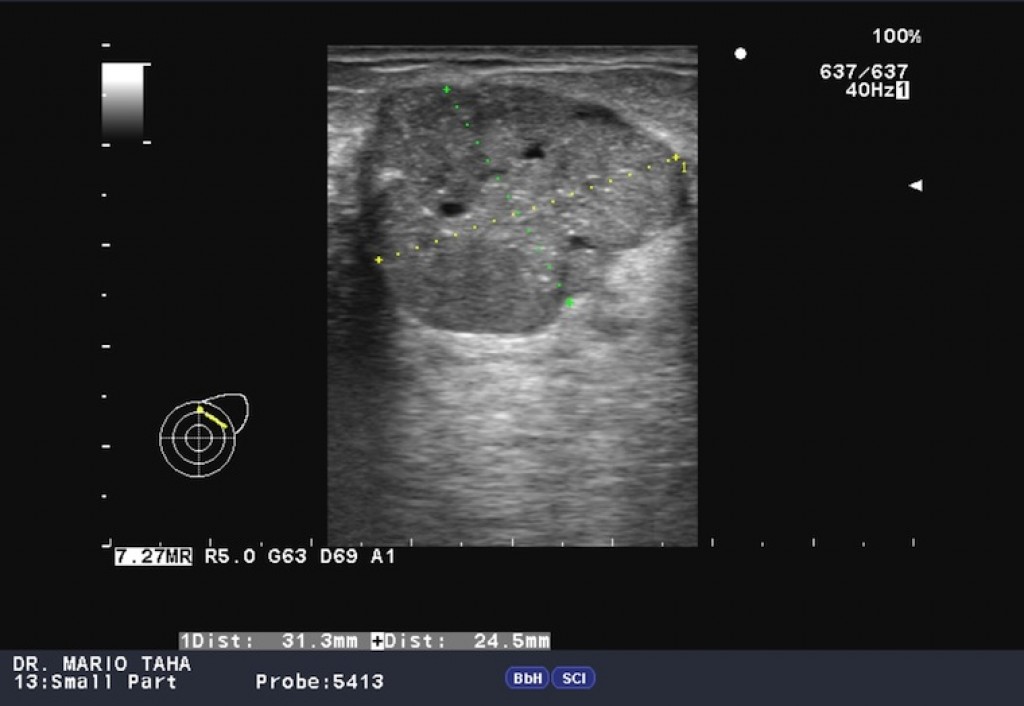 Phyllodes breast tumour on ultrasound image No. 1