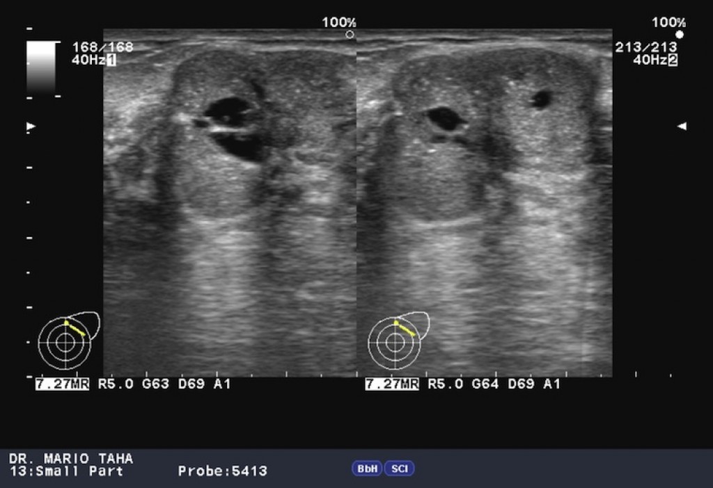 Phyllodes breast tumour on ultrasound image No. 2
