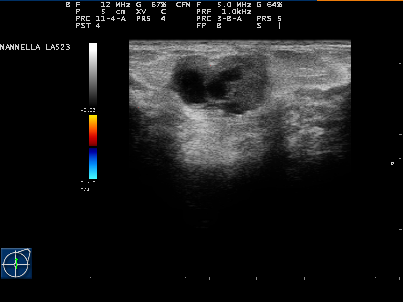 Phyllodes breast tumour on ultrasound image No. 3
