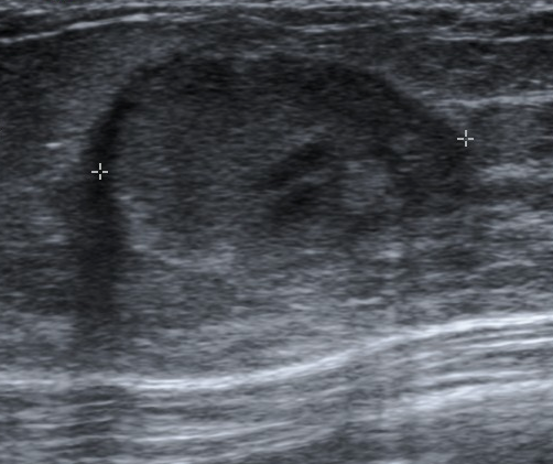 Galactocele on ultrasound